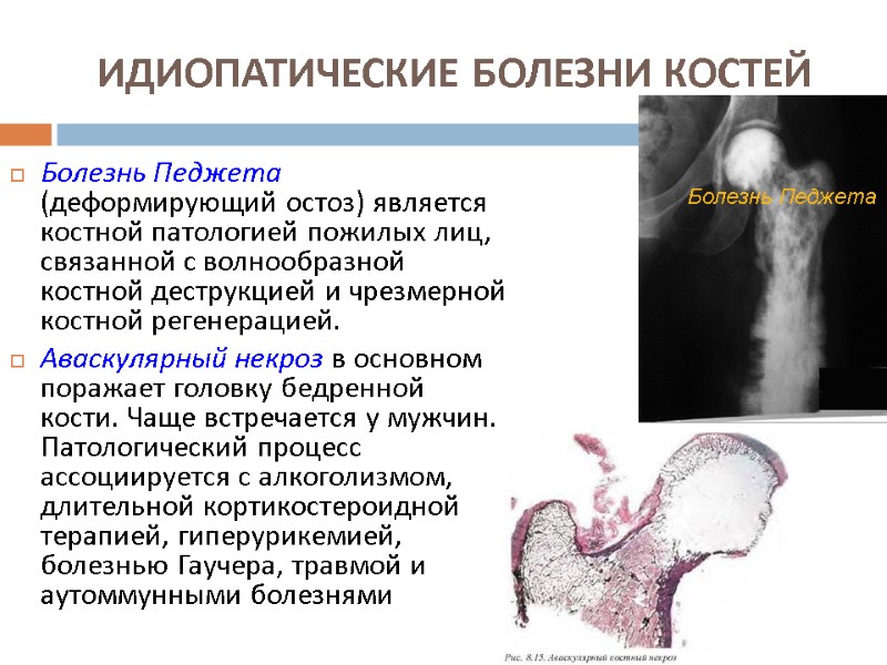 ИДИОПАТИЧЕСКИЕ БОЛЕЗНИ КОСТЕЙ  Болезнь Педжета (деформирующий остоз) является костной патологией пожилых лиц, связанной